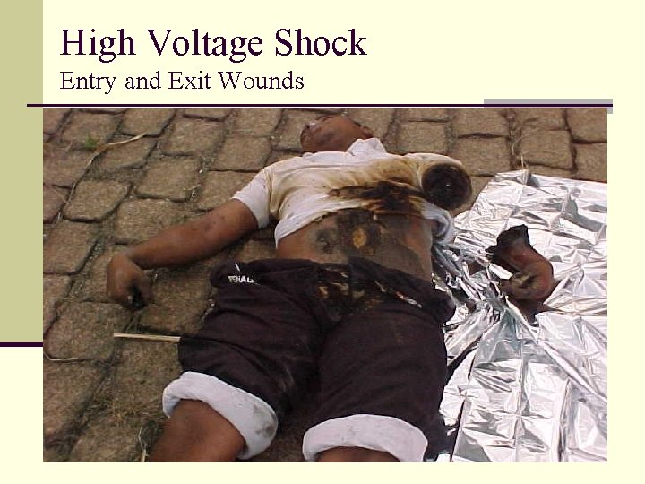 High Voltage Shock Entry and Exit Wounds 