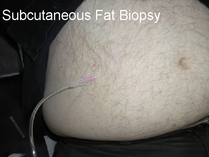 Subcutaneous Fat Biopsy 