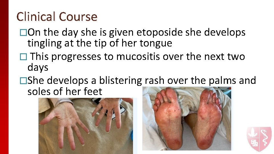Clinical Course �On the day she is given etoposide she develops tingling at the
