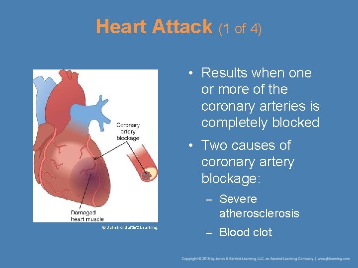 Heart Attack (1 of 4) • Results when one or more of the coronary