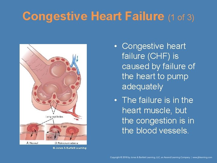 Congestive Heart Failure (1 of 3) • Congestive heart failure (CHF) is caused by
