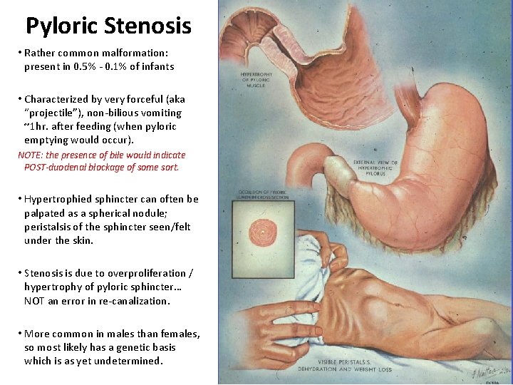 Pyloric Stenosis • Rather common malformation: present in 0. 5% - 0. 1% of