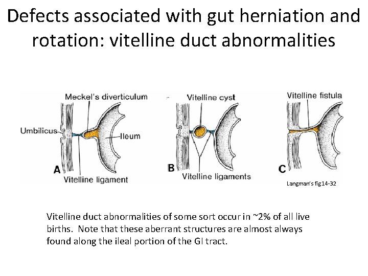 Defects associated with gut herniation and rotation: vitelline duct abnormalities Langman’s fig 14 -32