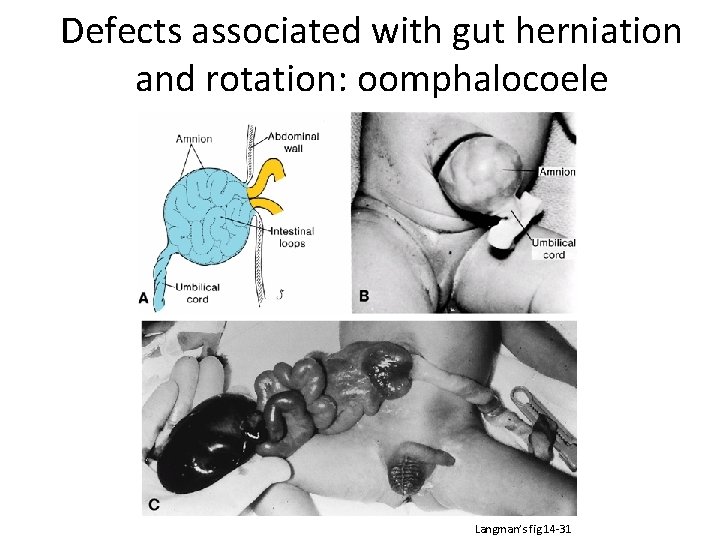 Defects associated with gut herniation and rotation: oomphalocoele Langman’s fig 14 -31 