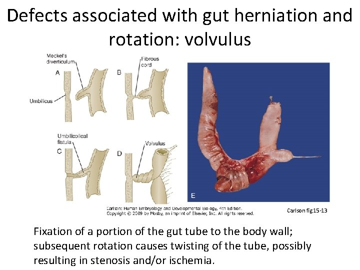 Defects associated with gut herniation and rotation: volvulus Carlson fig 15 -13 Fixation of