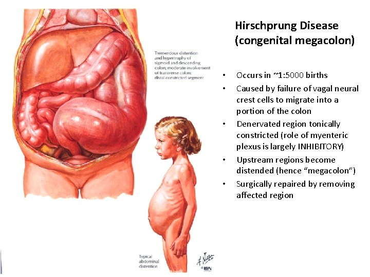 Hirschprung Disease (congenital megacolon) • • • Occurs in ~1: 5000 births Caused by