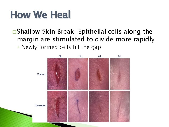 How We Heal � Shallow Skin Break: Epithelial cells along the margin are stimulated