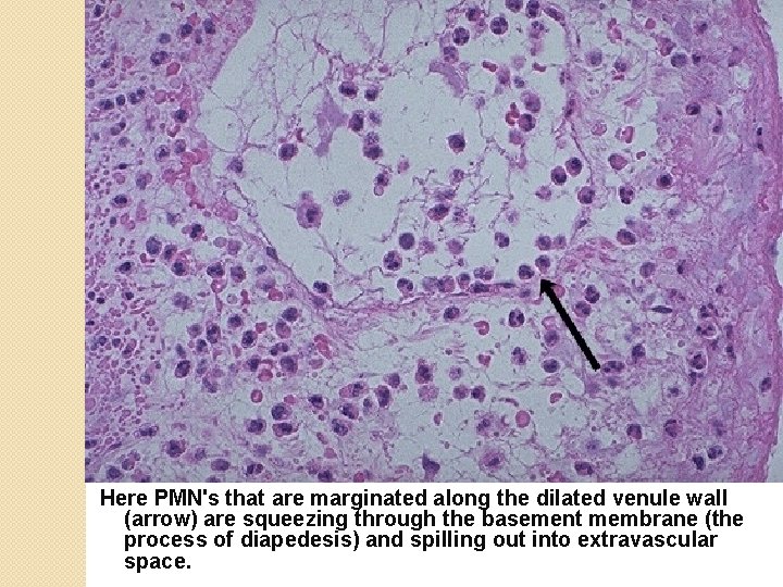 Here PMN's that are marginated along the dilated venule wall (arrow) are squeezing through