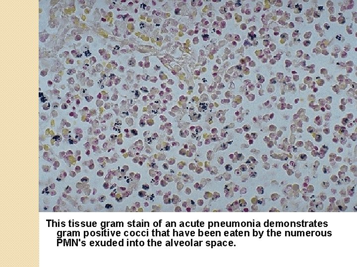 This tissue gram stain of an acute pneumonia demonstrates gram positive cocci that have