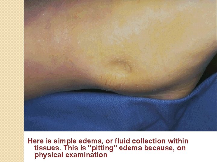 Here is simple edema, or fluid collection within tissues. This is "pitting" edema because,
