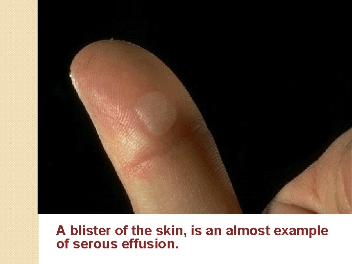 A blister of the skin, is an almost example of serous effusion. 