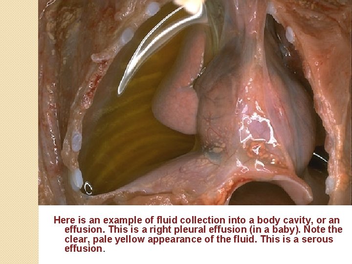 Here is an example of fluid collection into a body cavity, or an effusion.