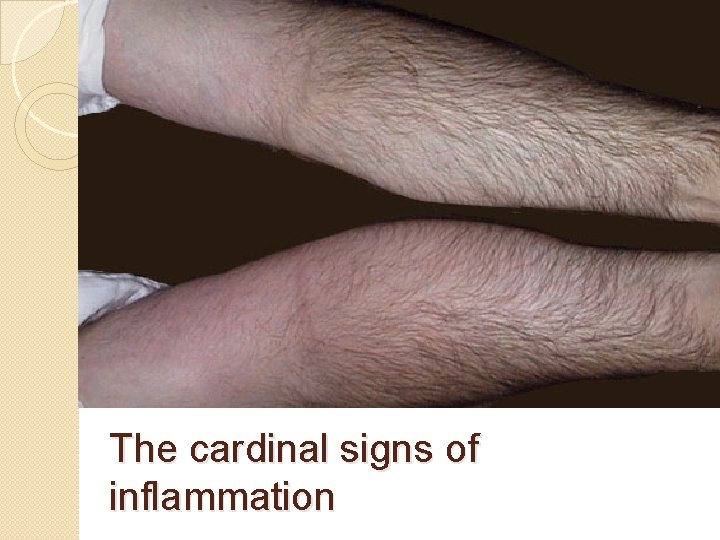 The cardinal signs of inflammation 