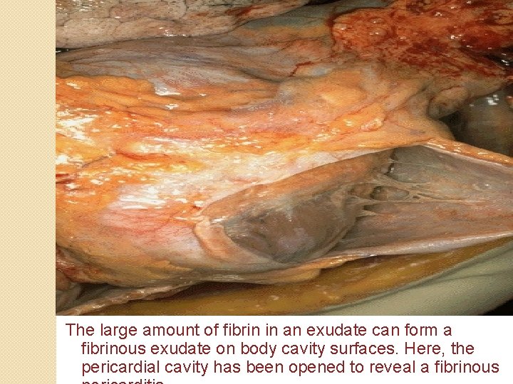 The large amount of fibrin in an exudate can form a fibrinous exudate on