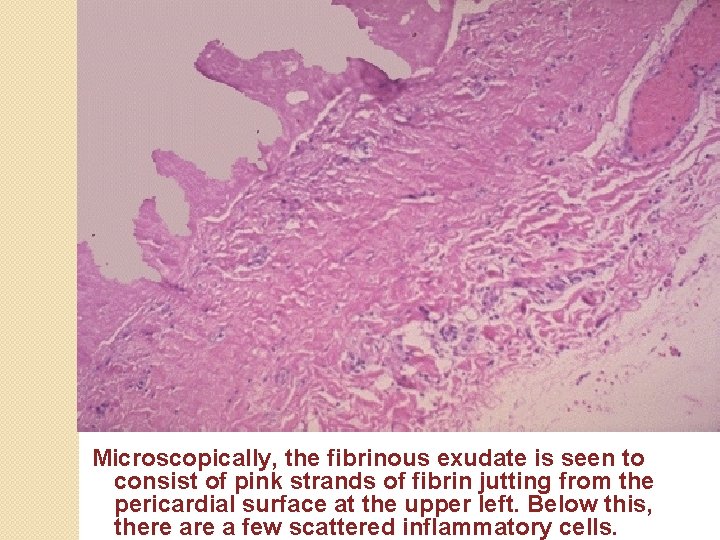 Microscopically, the fibrinous exudate is seen to consist of pink strands of fibrin jutting