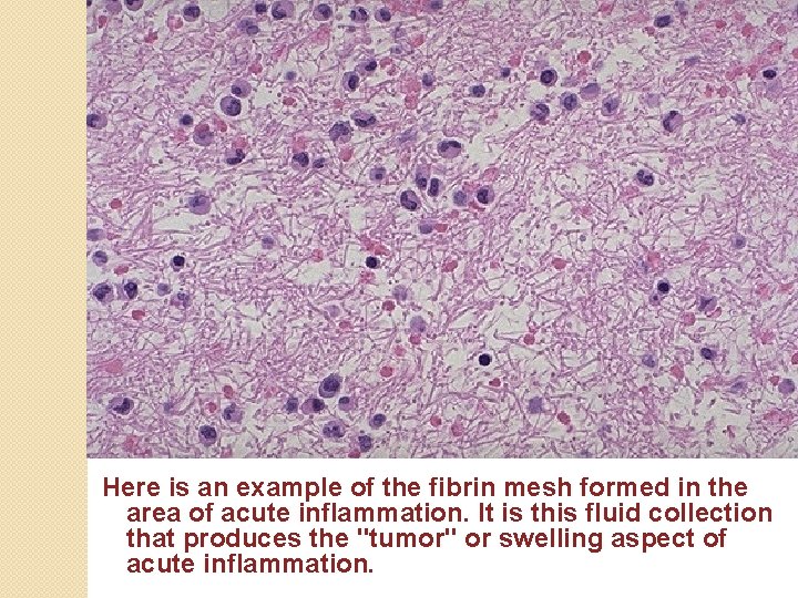 Here is an example of the fibrin mesh formed in the area of acute