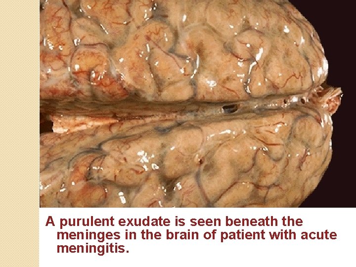 A purulent exudate is seen beneath the meninges in the brain of patient with