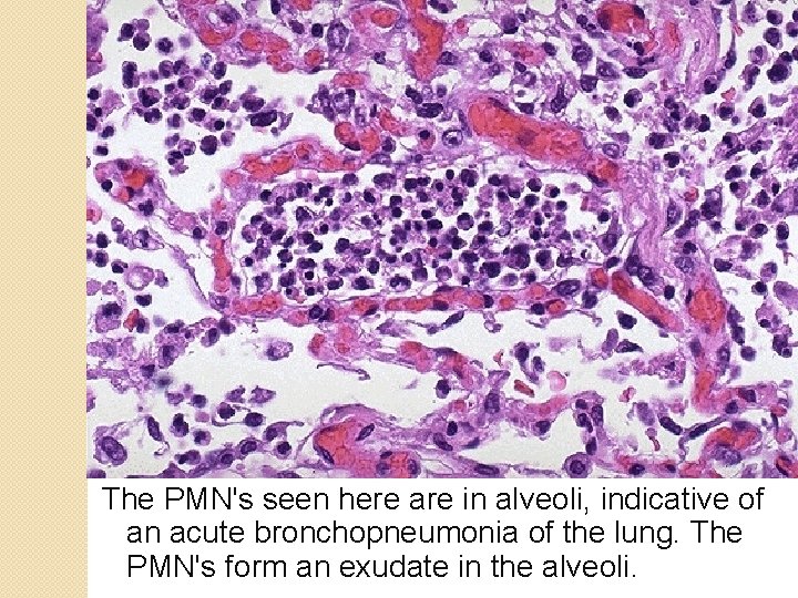 The PMN's seen here are in alveoli, indicative of an acute bronchopneumonia of the