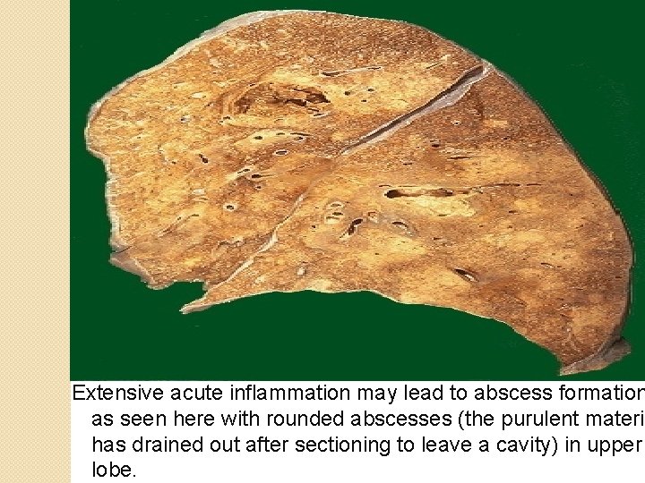 Extensive acute inflammation may lead to abscess formation as seen here with rounded abscesses