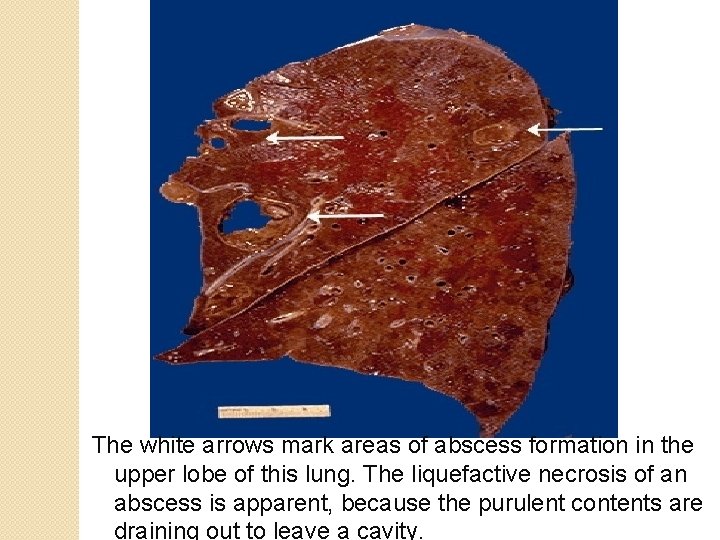 The white arrows mark areas of abscess formation in the upper lobe of this