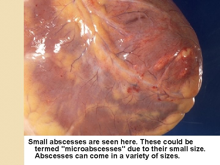 Small abscesses are seen here. These could be termed "microabscesses" due to their small