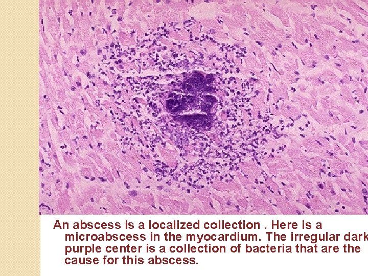 An abscess is a localized collection. Here is a microabscess in the myocardium. The