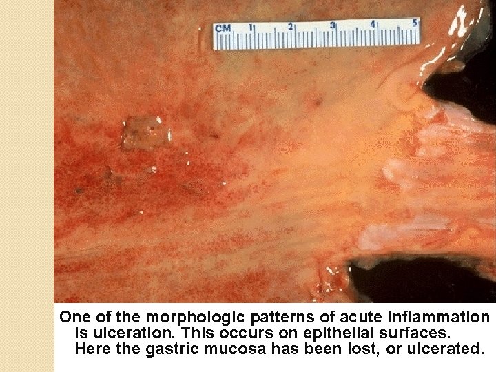 One of the morphologic patterns of acute inflammation is ulceration. This occurs on epithelial