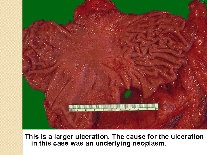 This is a larger ulceration. The cause for the ulceration in this case was