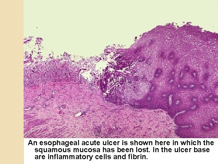 An esophageal acute ulcer is shown here in which the squamous mucosa has been