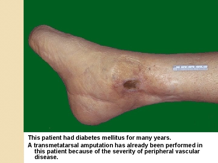 This patient had diabetes mellitus for many years. A transmetatarsal amputation has already been