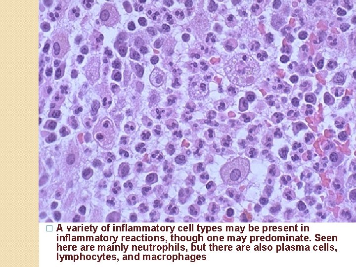 � A variety of inflammatory cell types may be present in inflammatory reactions, though