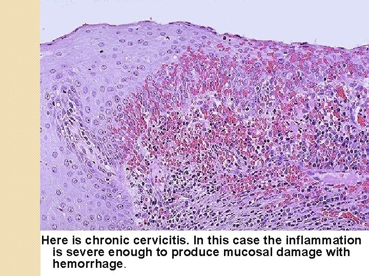 Here is chronic cervicitis. In this case the inflammation is severe enough to produce