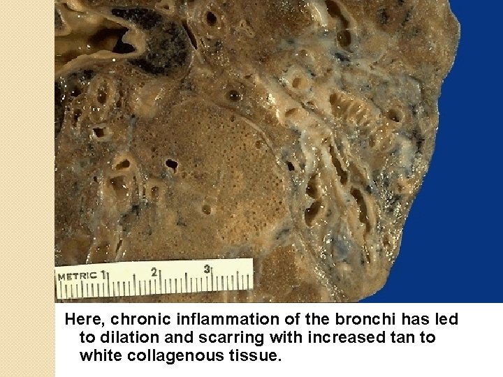 Here, chronic inflammation of the bronchi has led to dilation and scarring with increased