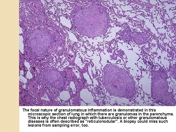The focal nature of granulomatous inflammation is demonstrated in this microscopic section of lung