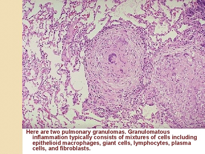 Here are two pulmonary granulomas. Granulomatous inflammation typically consists of mixtures of cells including
