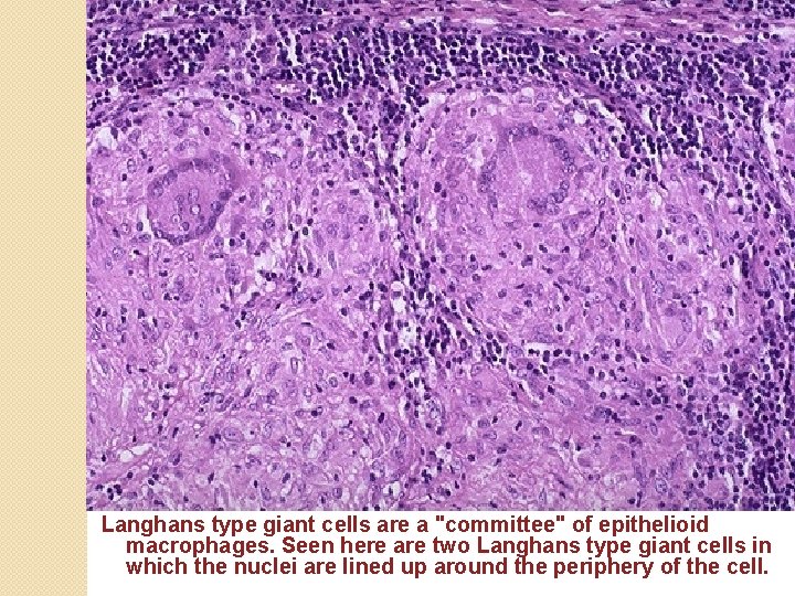Langhans type giant cells are a "committee" of epithelioid macrophages. Seen here are two