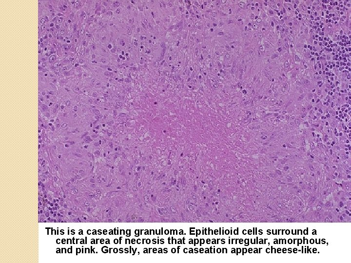 This is a caseating granuloma. Epithelioid cells surround a central area of necrosis that