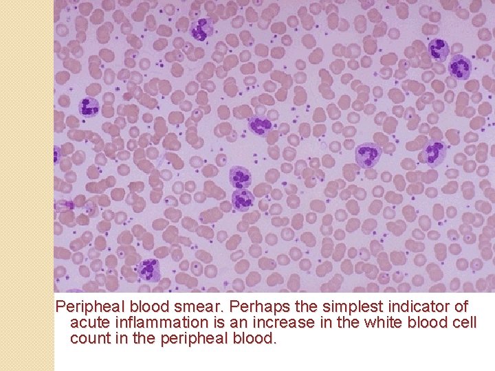 Peripheal blood smear. Perhaps the simplest indicator of acute inflammation is an increase in