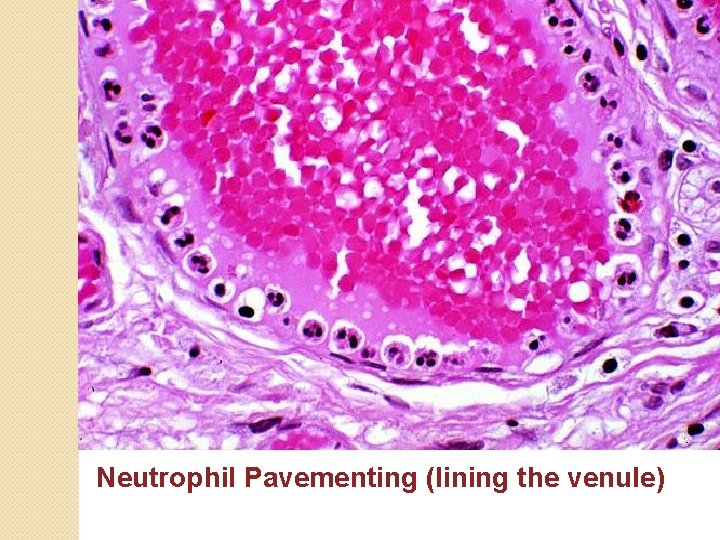 Neutrophil Pavementing (lining the venule) 