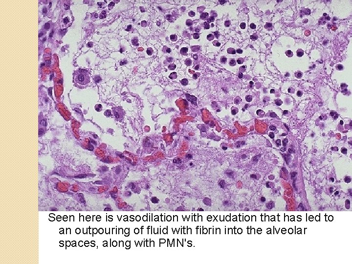 Seen here is vasodilation with exudation that has led to an outpouring of fluid