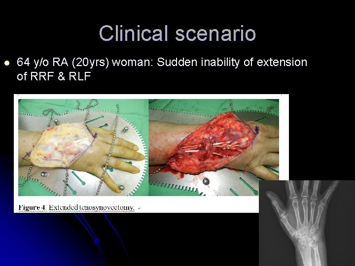 Clinical scenario l 64 y/o RA (20 yrs) woman: Sudden inability of extension of