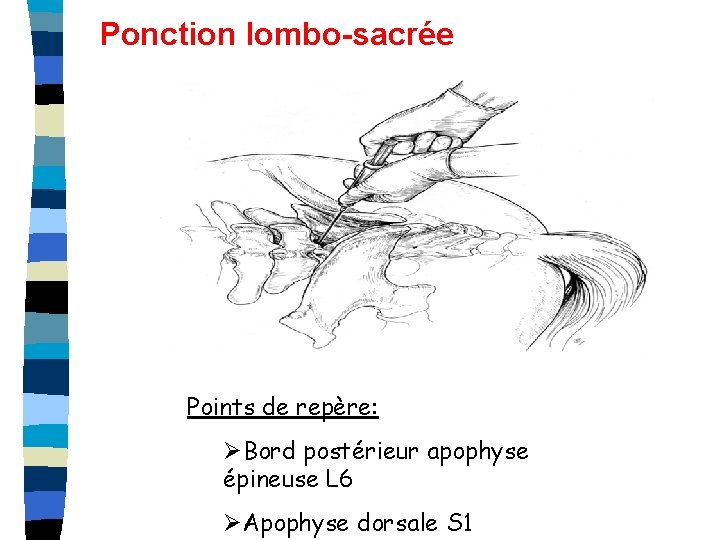 Ponction lombo-sacrée Points de repère: ØBord postérieur apophyse épineuse L 6 ØApophyse dorsale S