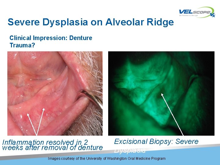 Severe Dysplasia on Alveolar Ridge Clinical Impression: Denture Trauma? Inflammation resolved in 2 weeks