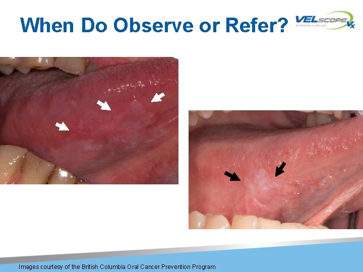When Do Observe or Refer? Images courtesy of the British Columbia Oral Cancer Prevention