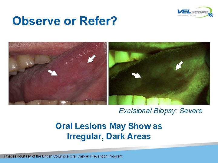 Observe or Refer? Excisional Biopsy: Severe Dysplasia Oral Lesions May Show as Irregular, Dark