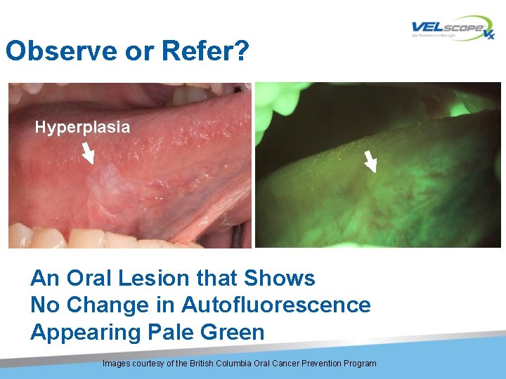 Observe or Refer? Hyperplasia An Oral Lesion that Shows No Change in Autofluorescence Appearing