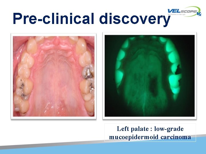 Pre-clinical discovery Left palate : low-grade mucoepidermoid carcinoma 