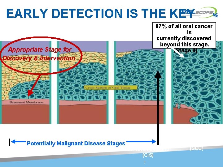 EARLY DETECTION IS THE KEY 67% of all oral cancer is currently discovered beyond