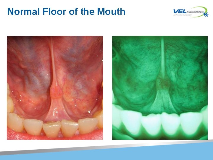 Normal Floor of the Mouth 