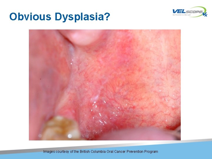 Obvious Dysplasia? Images courtesy of the British Columbia Oral Cancer Prevention Program 